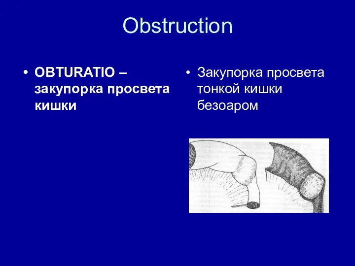 Obstruction OBTURATIO – закупорка просвета кишки Закупорка просвета тонкой кишки безоаром