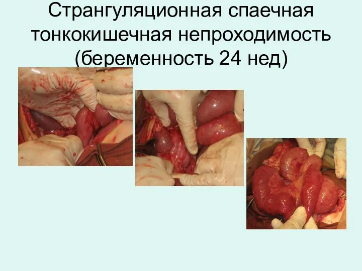 Странгуляционная спаечная тонкокишечная непроходимость (беременность 24 нед)