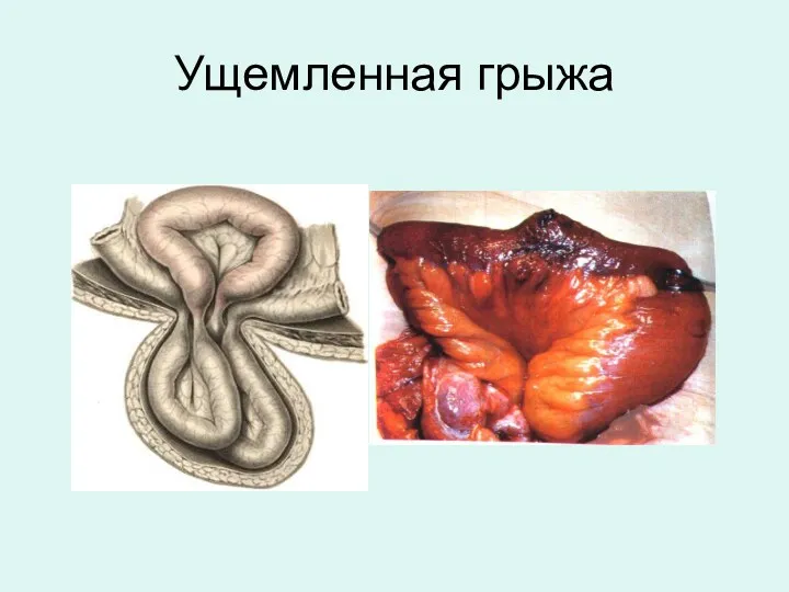 Ущемленная грыжа