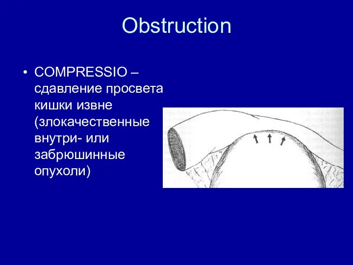 Obstruction COMPRESSIO – сдавление просвета кишки извне (злокачественные внутри- или забрюшинные опухоли)