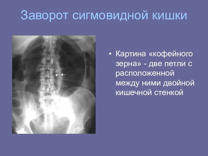 Заворот сигмовидной кишки Картина «кофейного зерна» - две петли с расположенной между ними двойной кишечной стенкой