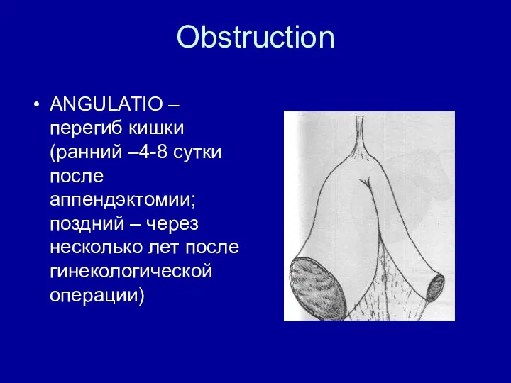 Obstruction ANGULATIO – перегиб кишки (ранний –4-8 сутки после аппендэктомии; поздний – через