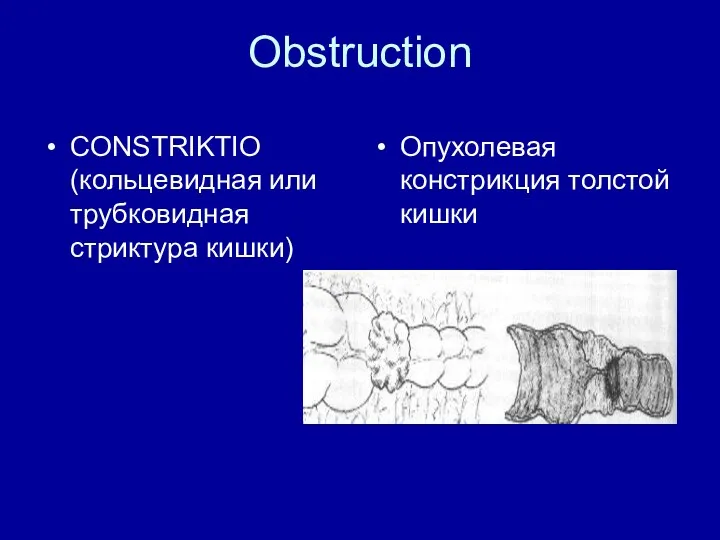 Obstruction CONSTRIKTIO (кольцевидная или трубковидная стриктура кишки) Опухолевая констрикция толстой кишки