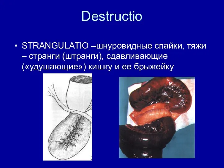 Destructio STRANGULATIO –шнуровидные спайки, тяжи – странги (штранги), сдавливающие («удушающие») кишку и ее брыжейку