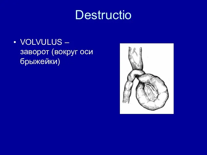 Destructio VOLVULUS – заворот (вокруг оси брыжейки)