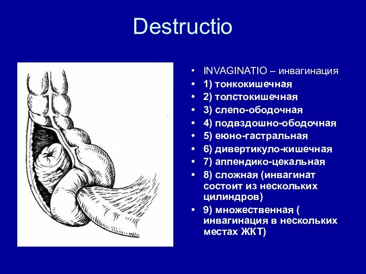 Destructio INVAGINATIO – инвагинация 1) тонкокишечная 2) толстокишечная 3) слепо-ободочная 4) подвздошно-ободочная 5)