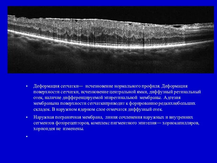 Эпиретинальная мембрана— Морфологическиеиз-менения— Деформация сетчатки— исчезновение нормального профиля. Деформация поверхности