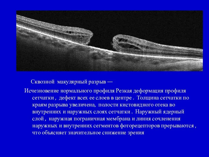 Сквозной макулярный разрыв — Исчезновение нормального профиля Резкая деформация профиля