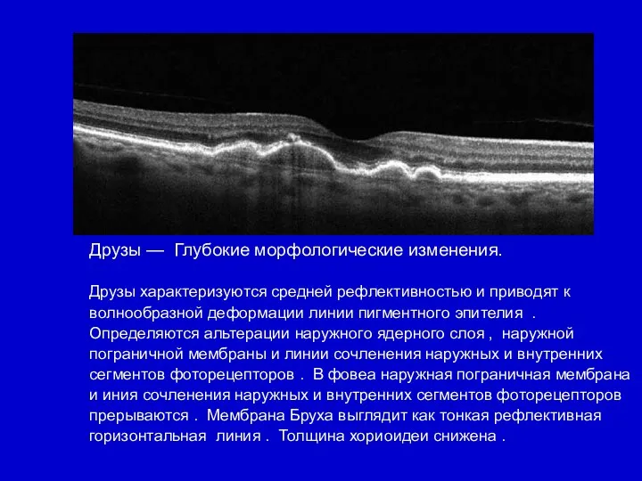 Друзы — Глубокие морфологические изменения. Друзы характеризуются средней рефлективностью и