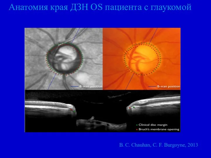 Анатомия края ДЗН OS пациента с глаукомой B. C. Chauhan, C. F. Burgoyne, 2013