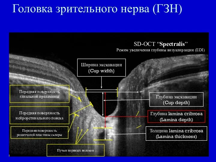 Головка зрительного нерва (ГЗН) НРП