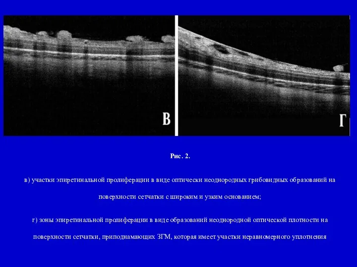 Рис. 2. в) участки эпиретинальной пролиферации в виде оптически неоднородных