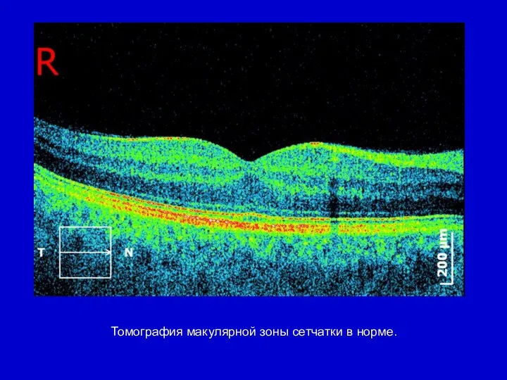 Томография макулярной зоны сетчатки в норме.