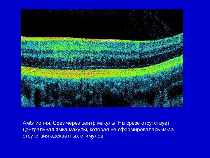 Амблиопия. Срез через центр макулы. На срезе отсутствует центральная ямка