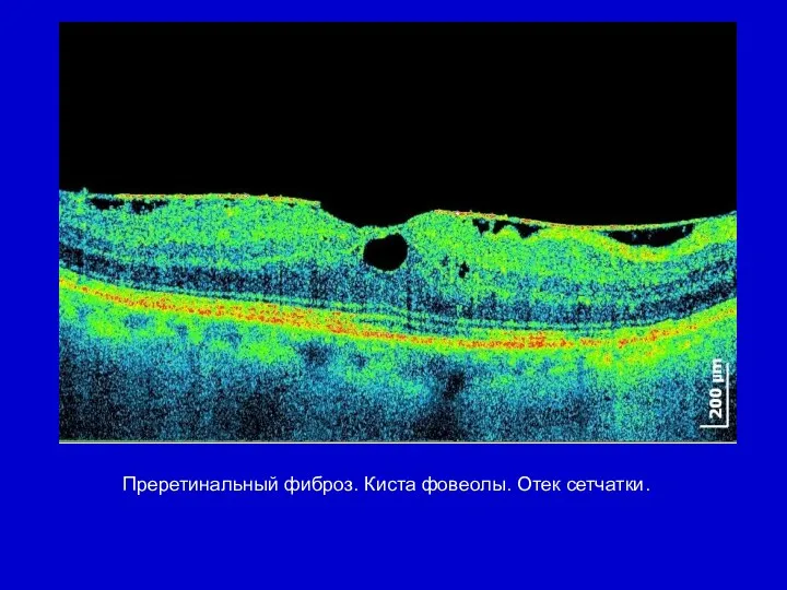 Преретинальный фиброз. Киста фовеолы. Отек сетчатки.