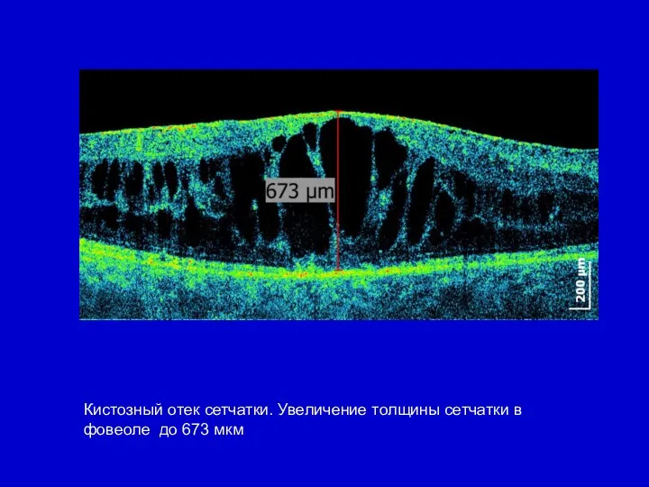 Кистозный отек сетчатки. Увеличение толщины сетчатки в фовеоле до 673 мкм