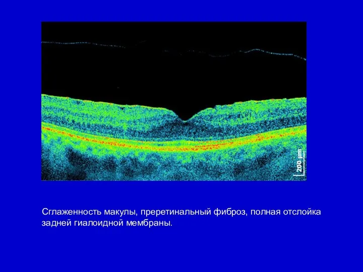 Сглаженность макулы, преретинальный фиброз, полная отслойка задней гиалоидной мембраны.