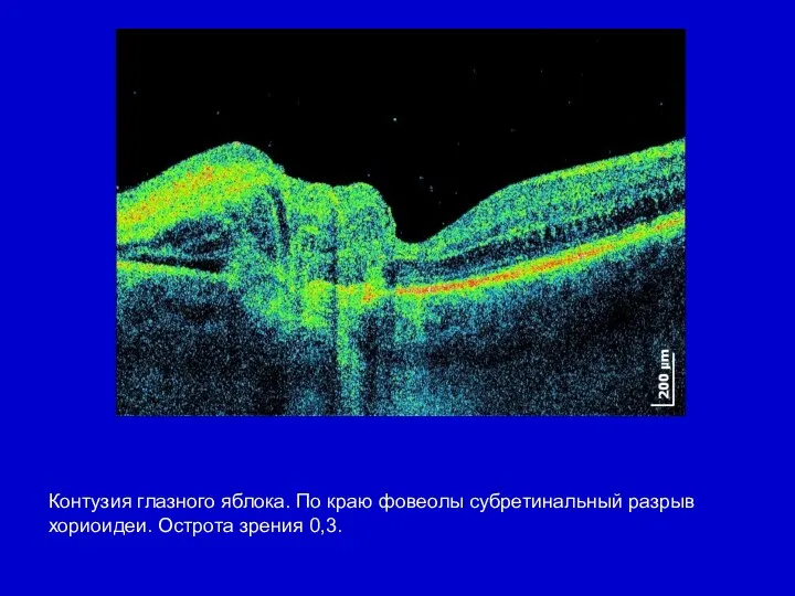 Контузия глазного яблока. По краю фовеолы субретинальный разрыв хориоидеи. Острота зрения 0,3.