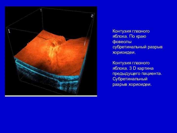 Контузия глазного яблока. По краю фовеолы субретинальный разрыв хориоидеи. Контузия