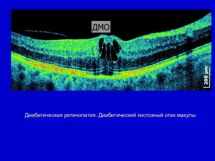 Диабетическая ретинопатия. Диабетический кистозный отек макулы.