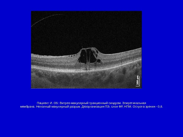 Пациент И. OS: Витрео-макулярный тракционный синдром. Эпиретинальная мембрана. Неполный макулярный