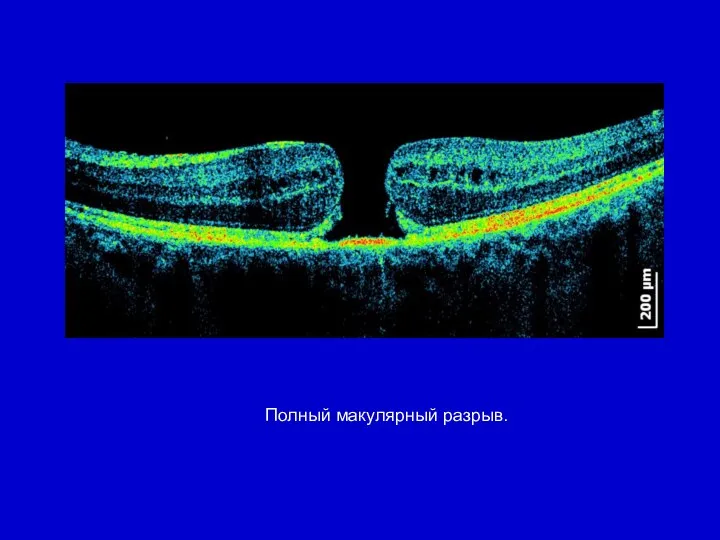 Полный макулярный разрыв.