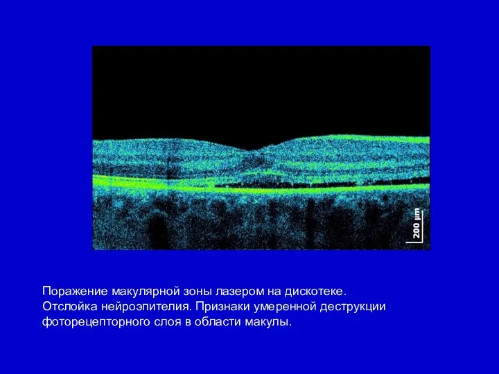 Поражение макулярной зоны лазером на дискотеке. Отслойка нейроэпителия. Признаки умеренной деструкции фоторецепторного слоя в области макулы.