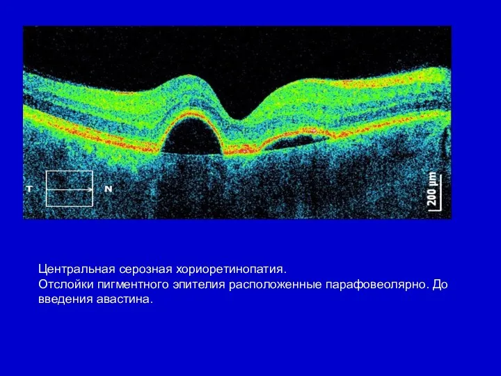 Центральная серозная хориоретинопатия. Отслойки пигментного эпителия расположенные парафовеолярно. До введения авастина.