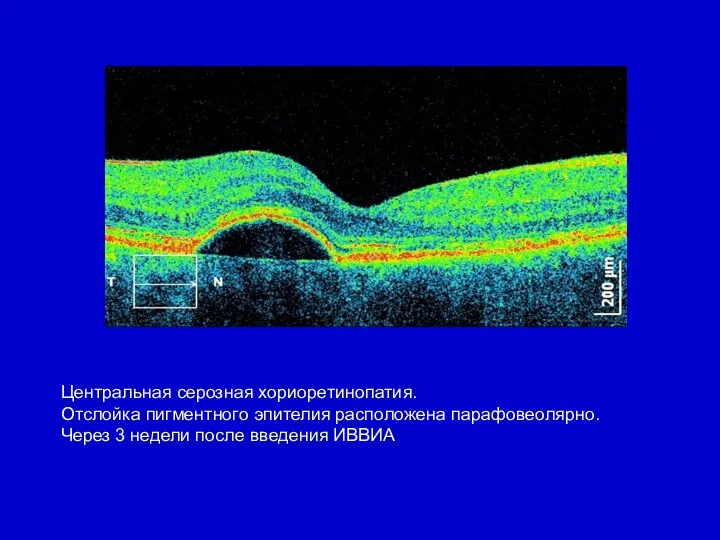 Центральная серозная хориоретинопатия. Отслойка пигментного эпителия расположена парафовеолярно. Через 3 недели после введения ИВВИА