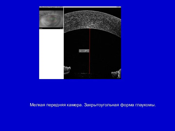 Мелкая передняя камера. Закрытоугольная форма глаукомы.