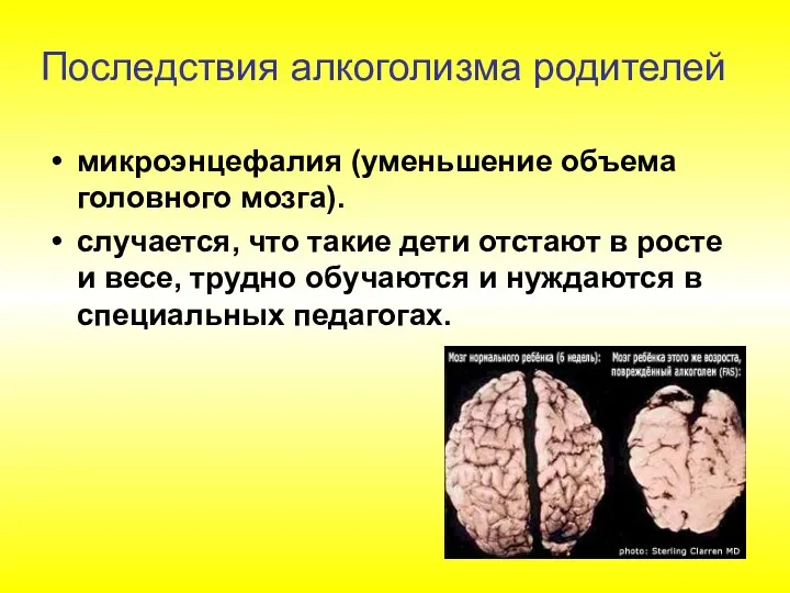 микроэнцефалия (уменьшение объема головного мозга). случается, что такие дети отстают в росте и