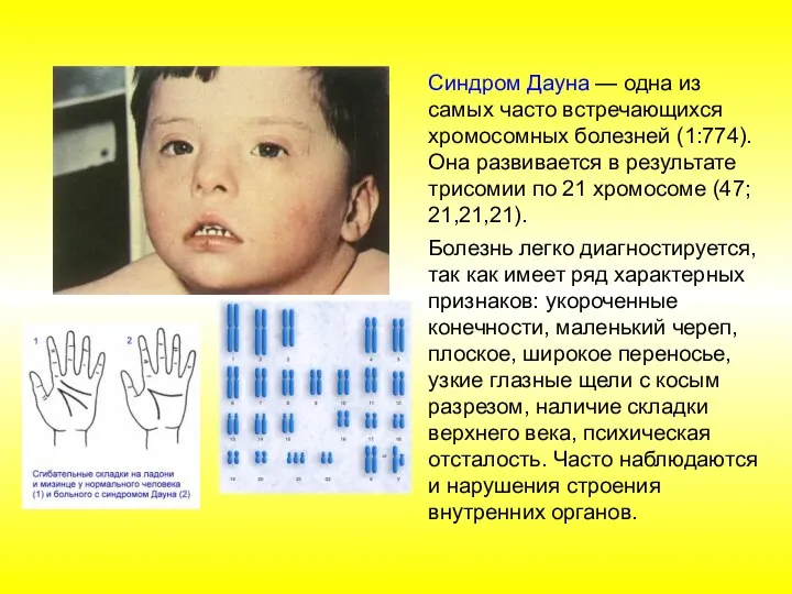 Синдром Дауна — одна из самых часто встречающихся хромосомных болезней (1:774). Она развивается