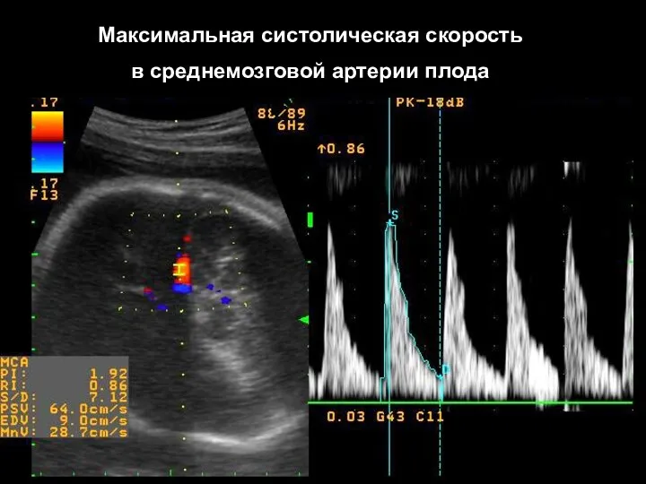 Максимальная систолическая скорость в среднемозговой артерии плода