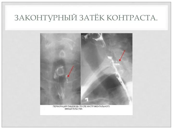 ЗАКОНТУРНЫЙ ЗАТЁК КОНТРАСТА.