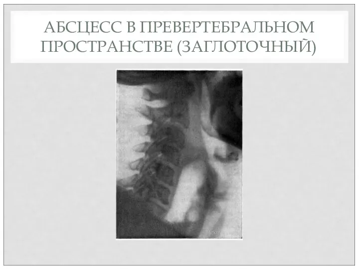 АБСЦЕСС В ПРЕВЕРТЕБРАЛЬНОМ ПРОСТРАНСТВЕ (ЗАГЛОТОЧНЫЙ)