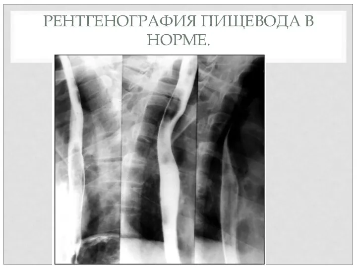 РЕНТГЕНОГРАФИЯ ПИЩЕВОДА В НОРМЕ.