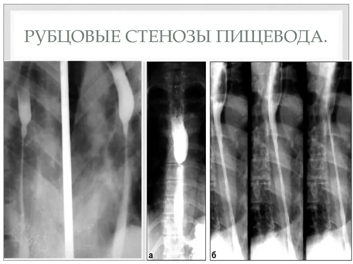 РУБЦОВЫЕ СТЕНОЗЫ ПИЩЕВОДА.