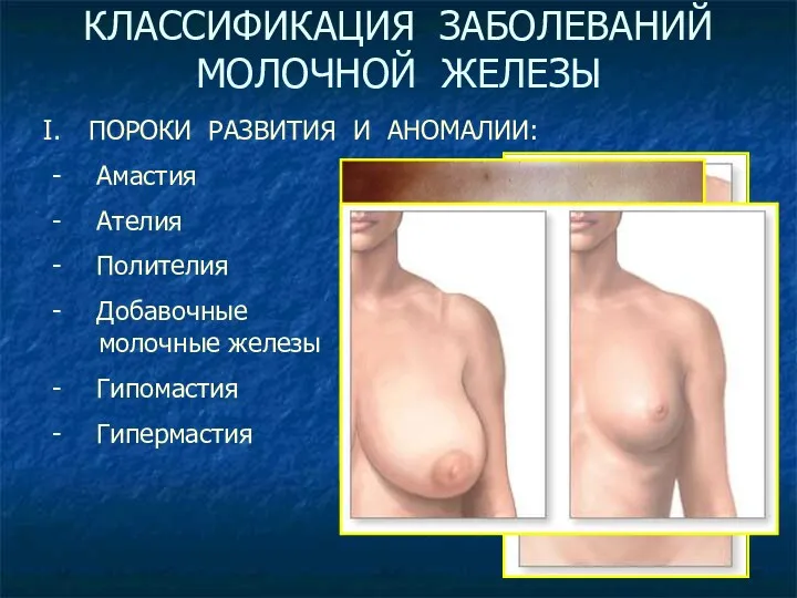 КЛАССИФИКАЦИЯ ЗАБОЛЕВАНИЙ МОЛОЧНОЙ ЖЕЛЕЗЫ ПОРОКИ РАЗВИТИЯ И АНОМАЛИИ: Амастия Ателия Полителия Добавочные молочные железы Гипомастия Гипермастия