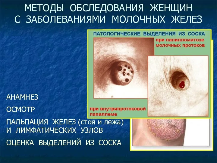 МЕТОДЫ ОБСЛЕДОВАНИЯ ЖЕНЩИН С ЗАБОЛЕВАНИЯМИ МОЛОЧНЫХ ЖЕЛЕЗ АНАМНЕЗ ОСМОТР ПАЛЬПАЦИЯ