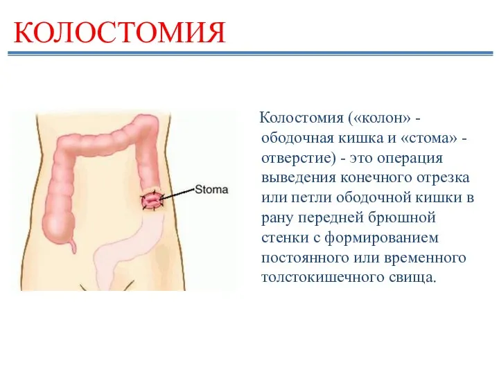 КОЛОСТОМИЯ Колостомия («колон» - ободочная кишка и «стома» - отверстие)