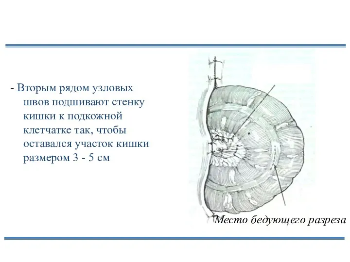 - Вторым рядом узловых швов подшивают стенку кишки к подкожной