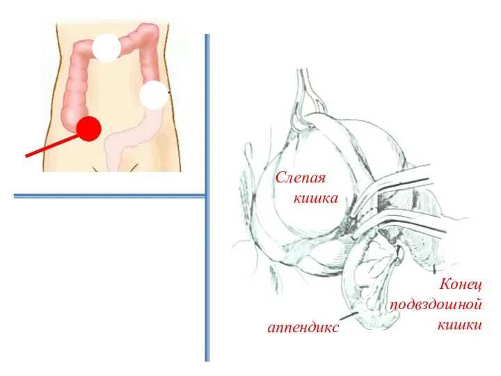 аппендикс Слепая кишка Конец подвздошной кишки