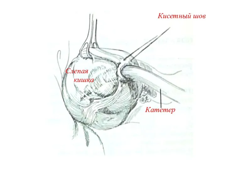 Кисетный шов Катетер Слепая кишка