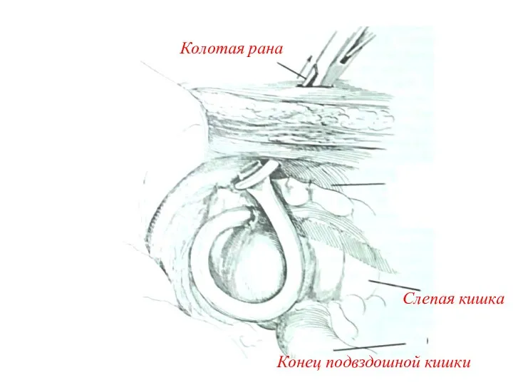 Колотая рана Слепая кишка Конец подвздошной кишки