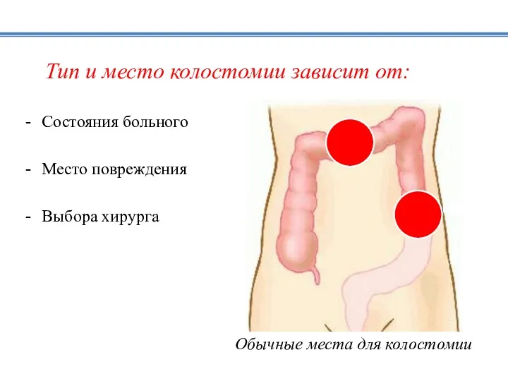 Тип и место колостомии зависит от: Состояния больного Место повреждения Выбора хирурга Обычные места для колостомии