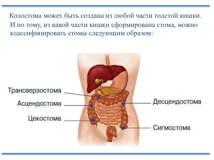 Колостома может быть создана из любой части толстой кишки. И