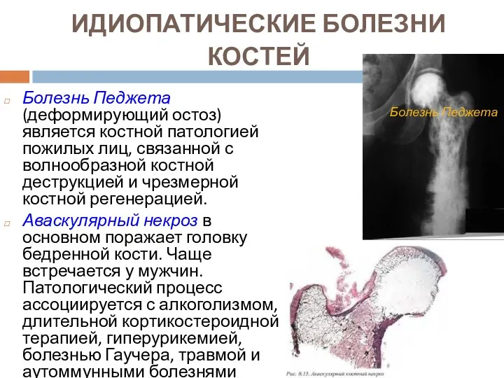ИДИОПАТИЧЕСКИЕ БОЛЕЗНИ КОСТЕЙ Болезнь Педжета (деформирующий остоз) является костной патологией пожилых лиц, связанной