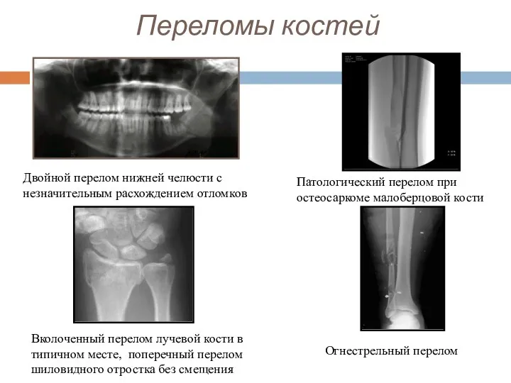 Переломы костей Двойной перелом нижней челюсти с незначительным расхождением отломков Патологический перелом при