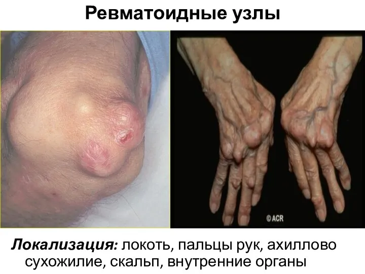 Ревматоидные узлы Локализация: локоть, пальцы рук, ахиллово сухожилие, скальп, внутренние органы