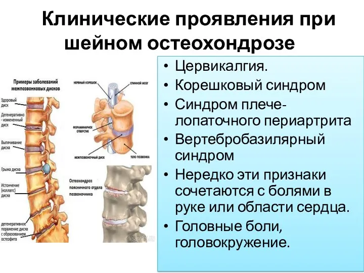 Клинические проявления при шейном остеохондрозе Цервикалгия. Корешковый синдром Синдром плече-лопаточного